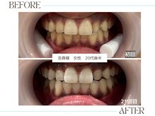 ホワイトニングサロンブライト 尼崎店(Whitening salon bright)/会員様のbefore/after