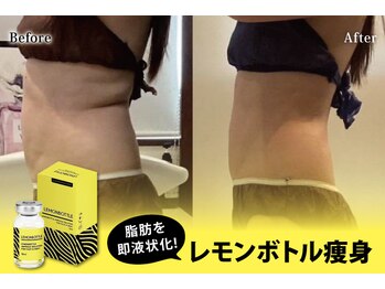 アネル 新都心店(anel)の写真/韓国で大人気の脂肪-溶解レモンボトル登場！レモンボトル導入後に脂肪燃焼マシンで医療を超える結果！ 