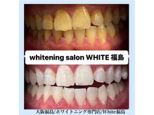 ホワイトニングサロン ホワイト(WHITE)/セルフホワイトニング/大阪/福島