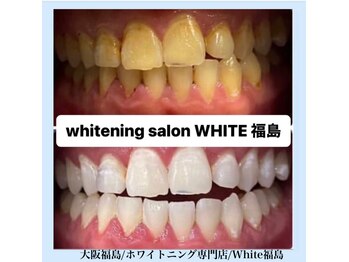 ホワイトニングサロン ホワイト(WHITE)/セルフホワイトニング/大阪/福島