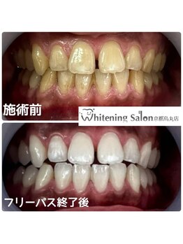 ホワイトニングサロン 京都烏丸店/ホワイトニング施術例