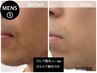 【メンズお手軽セット】　ヒゲ脱毛(スタッフ施術）＋　セルフ脱毛10分