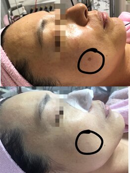 プリエール ビューティ/シミケア