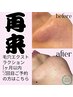 【2カ月以内２回目再来の方】毛穴エクストラクションで毛穴黒ずみ開き改善