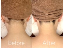 バーニー 梅田店(BARNEY)/脱毛