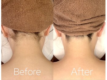 バーニー 梅田店(BARNEY)/脱毛