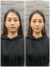 長寿鍼灸院 長寿整骨院/美容鍼25本の効果★小顔効果