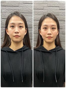 長寿鍼灸院 長寿整骨院/美容鍼25本の効果★小顔効果