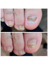 爪切り屋 足楽/【伸びない爪】