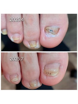 爪切り屋 足楽/【伸びない爪】