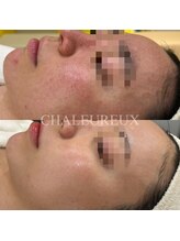 サロン ド ボーテ シャルル(Chaleureux)/肌悩み:長年の赤み炎症