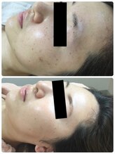 メイユール(MEILLEUR)/光フェイシャル6回