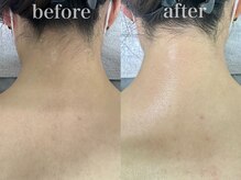 スリー(THREE)/都度払い脱毛【THREE】