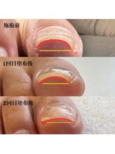 ネイルハウス リップル/巻き爪 Before After☆