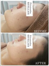 リセラージュ(Recellage)/毛穴洗浄フェイシャル×肌ファス