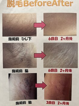 サロン ド ラム/脱毛効果