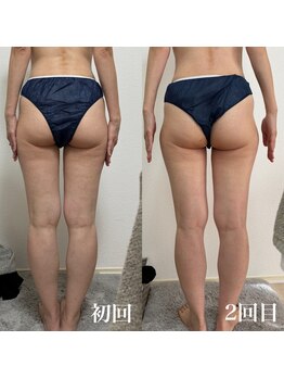 エステサロンブランシュ(Esthe salon Blanche)/ハイパーナイフ下半身痩せ