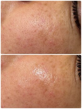 エンフィール(&.Feel)/ヒト幹細胞培養上清液導入コース