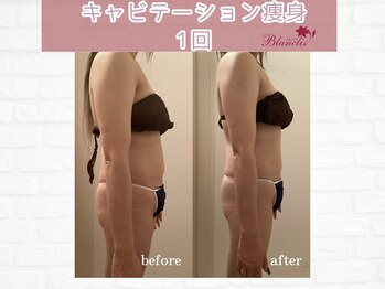 ブランリス(Blanclis)/痩身☆ビフォーアフター