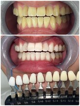 エクシアホワイトニング 町田店/ホワイトニングビフォーアフター