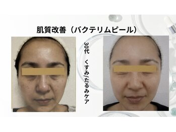 トレゾール(tresor)/★毛穴★30代（くすみ/たるみ）