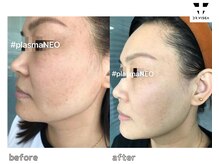 コル(COR)/特許施術の効果