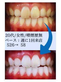 スマイルホワイト 練馬店/ホワイトニングBeforeAfter