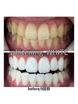 ホワイト 奈良桜井店(WHITE)の写真/【クリアな歯で好印象に！】1回で他の人と差がつく白い歯に★美白効果の高いセルフホワイトニング♪