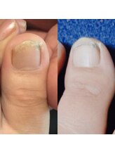 足もみサロン ループ(LOOP)/痛い爪対策