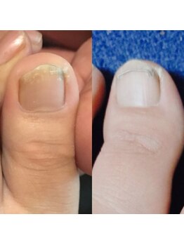 足もみサロン ループ(LOOP)/痛い爪対策