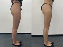 リノ(lino)/今話題のWINBACK♪痩身