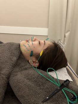 ヴィーライン 大阪梅田院(VeLine)/鍼灸／美容鍼／小顔／大阪／梅田