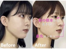 ラプリアンジュ 鹿児島天文館店(Raplit ange)/隆鼻+輪郭矯正40分　10回