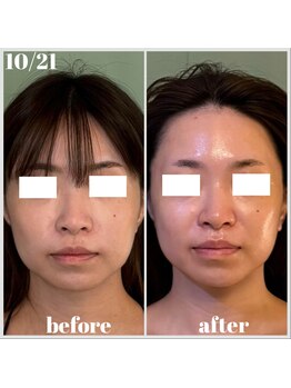 グロウズ(Glows)/小顔&たるみ改善