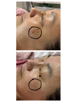 プリエール ビューティ/シミケア