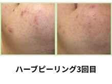 シェリール(Cherir)/ハーブピーリング