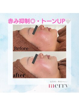 メリー 大和八木店(merry)/赤み抑制♪敏感肌で施術可能★
