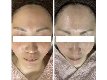 リボン(Ribbon)/人気No.2毛穴たるみor美白特化