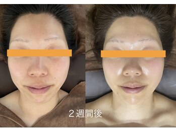 オチョビー(ocho.bee)/糸リフトビフォーアフター