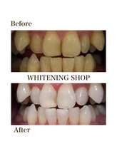 ホワイトニングショップ 銀座7丁目店(WHITENING SHOP)/Before After