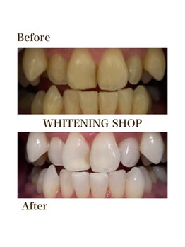 ホワイトニングショップ 銀座7丁目店(WHITENING SHOP)/Before After