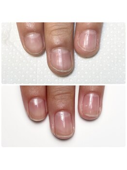 美爪育成ネイルケアで深爪緩和