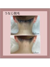 エステティック レイビス 秋田店(RAYVIS)/ブライダルや浴衣姿にも◎うなじ