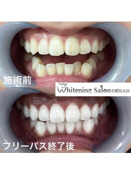 ホワイトニングサロン 京都烏丸店/ホワイトニング　施術例