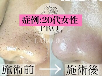 ラボキュー(LABO-9)/毛穴エクストラクションプロ