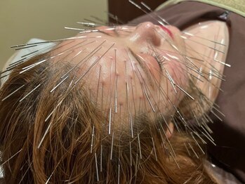 オリエントセラピー(ORIENT THERAPY)/ルート鍼(鬼神美容鍼)