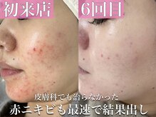 シルキー 新宿店(SILKY)の雰囲気（新宿/ハーブピーリング/フェイシャル/毛穴/毛穴洗浄/ニキビケア）