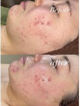 レシェルサロン(Lechelle Salon)/レモンボトルお顔3部位　2回目　