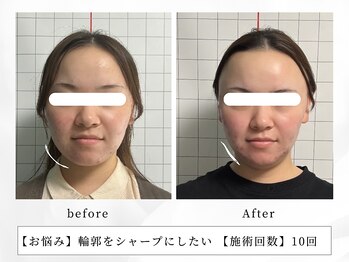 レッド(RED)/輪郭すっきり!エラ張り解消