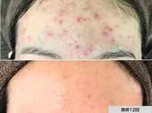 ニキビ研究所 千葉店/おでこニキビでお悩みの方へ！